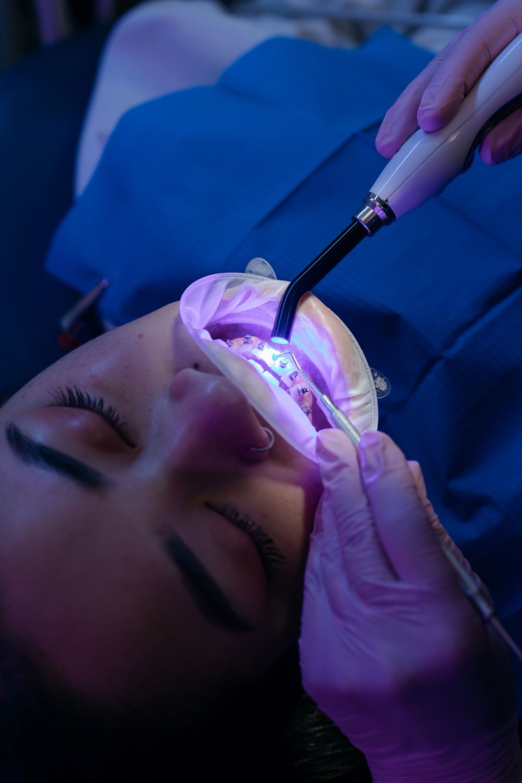 Procedimento ortodôntico com fotopolimerização em paciente com aparelho